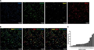 Prognostic Value of Galectin-9 Relates to Programmed Death-Ligand 1 in Patients With Multiple Myeloma